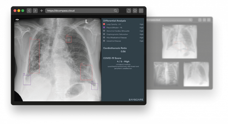 Rayscape-Lung-CXR.png